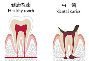 虫歯のメカニズム　健康な歯と虫歯