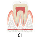虫歯の初期段階 C1　自覚症状があることも