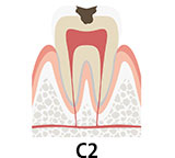 虫歯の段階 C2　虫歯が象牙質にまで及んだ状態