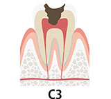 虫歯の段階 C3　虫歯が神経にまで到達した状態
