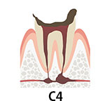 虫歯の段階 C4　歯が溶けて根だけが残った状態